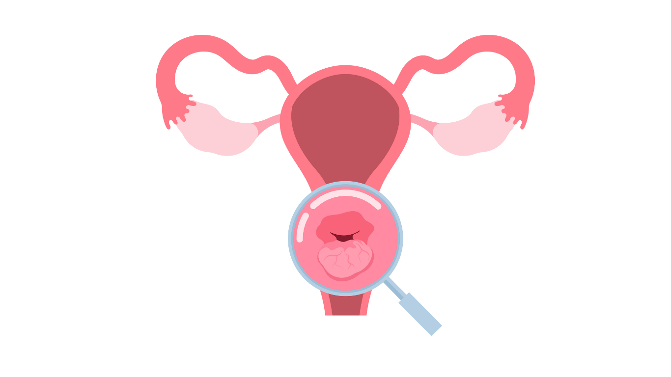 Cervical Cancer