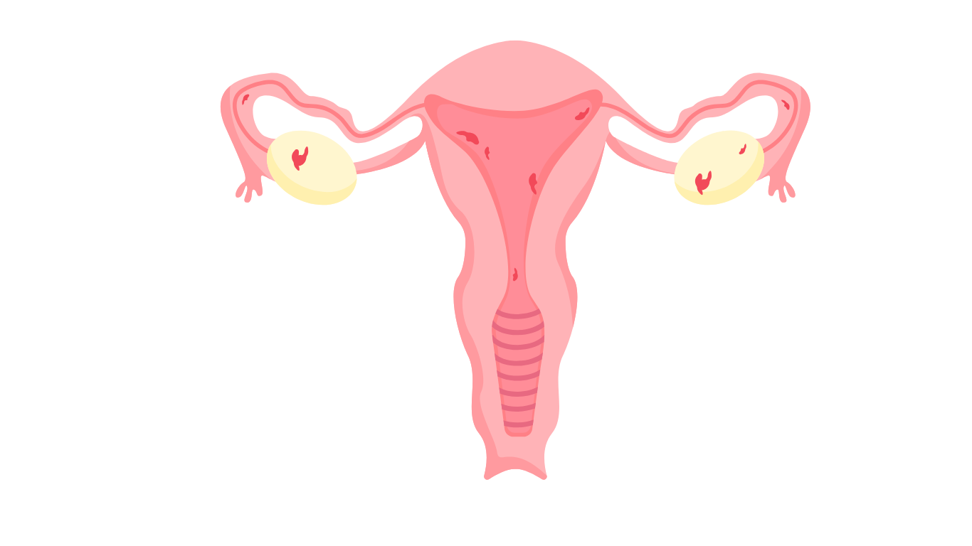 Endometriosis