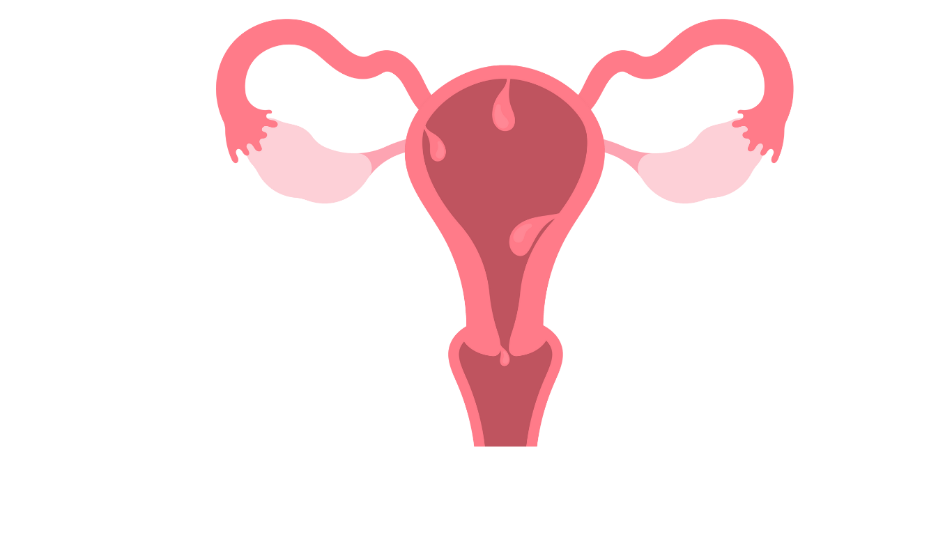 Uterine Fibroids