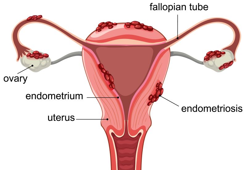 endometriosis symptoms and treatment options